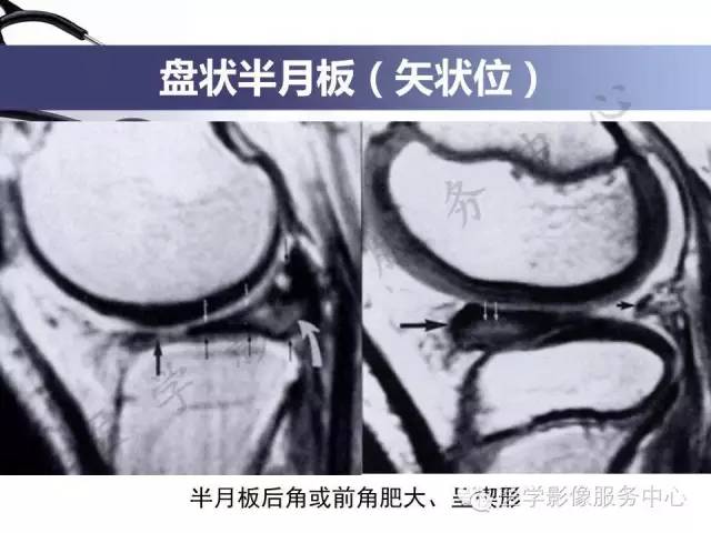 【PPT】半月板病变的MRI诊断