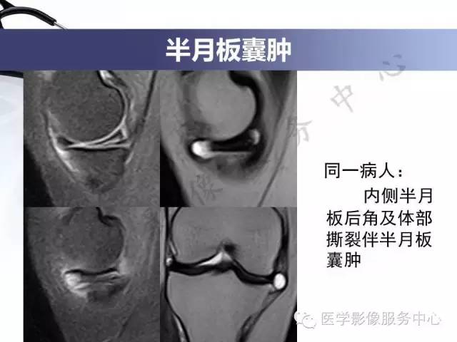 【PPT】半月板病变的MRI诊断