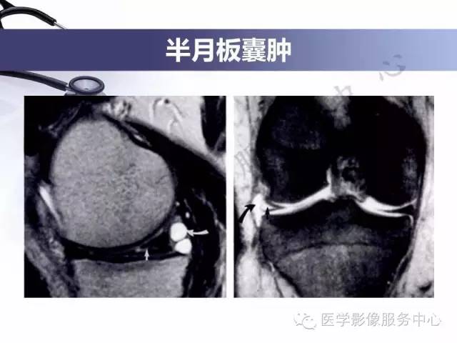 【PPT】半月板病变的MRI诊断