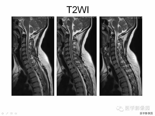 【病例】自发性脊髓硬膜外血肿1例MR影像表现