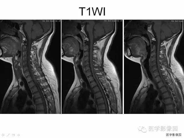 【病例】自发性脊髓硬膜外血肿1例MR影像表现