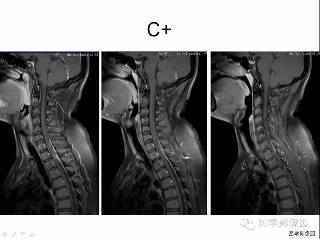 【病例】自发性脊髓硬膜外血肿1例MR影像表现