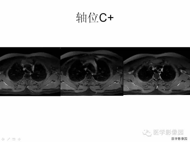 【病例】自发性脊髓硬膜外血肿1例MR影像表现