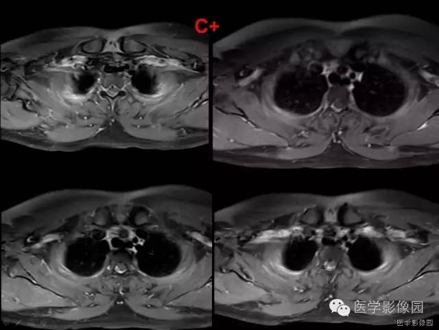 【病例】自发性脊髓硬膜外血肿1例MR影像表现