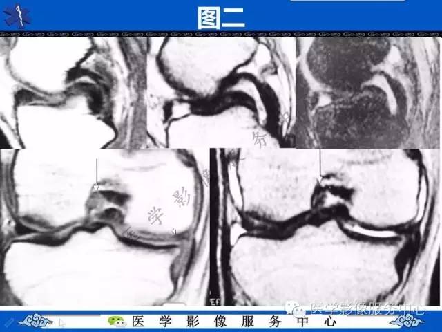 【影像征象】双后交叉韧带征