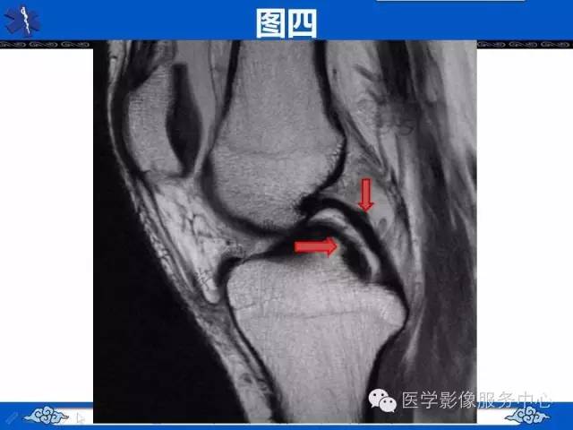 【影像征象】双后交叉韧带征