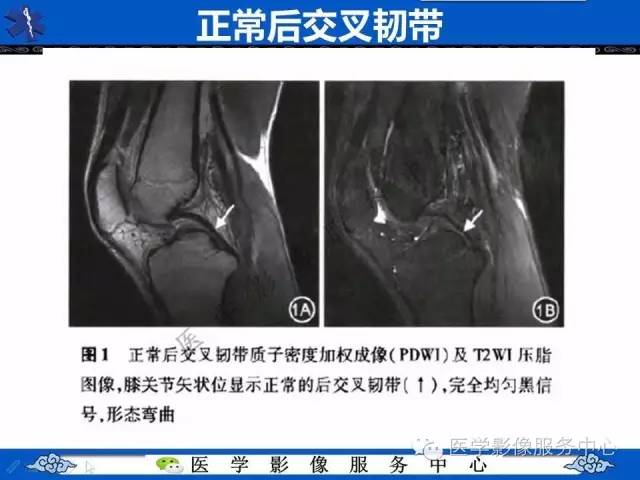 【影像征象】双后交叉韧带征