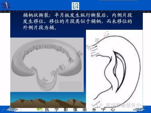 【影像征象】双后交叉韧带征