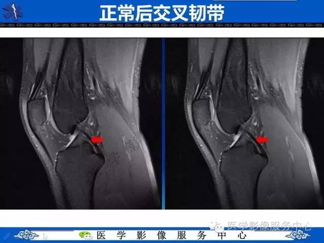 【影像征象】双后交叉韧带征