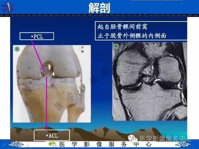 【影像征象】双后交叉韧带征