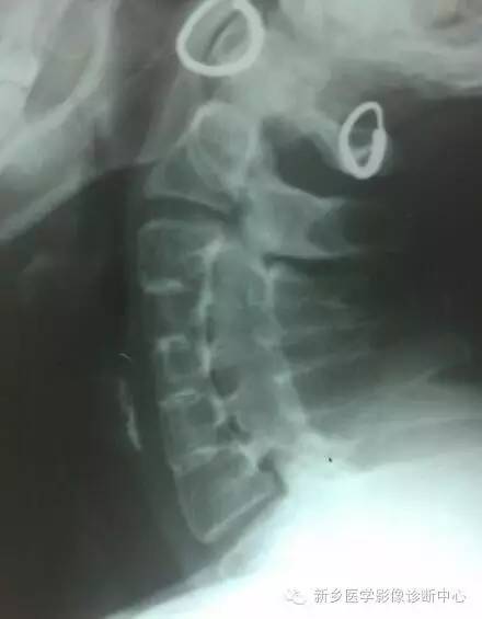 Klippel-Feil综合征