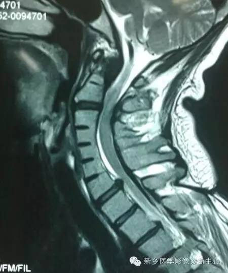 Klippel-Feil综合征