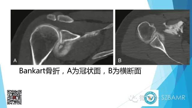 【PPT】(40种)特殊骨折命名方法及图示