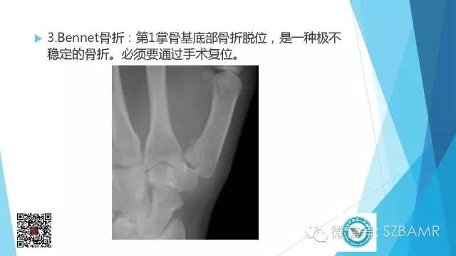 【PPT】(40种)特殊骨折命名方法及图示