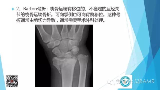 【PPT】(40种)特殊骨折命名方法及图示