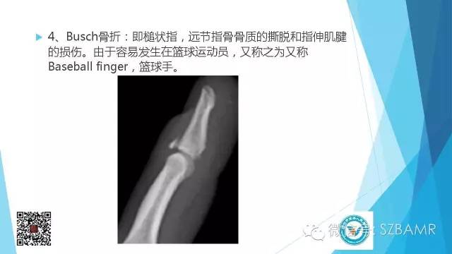 【PPT】(40种)特殊骨折命名方法及图示