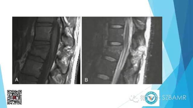 【PPT】(40种)特殊骨折命名方法及图示
