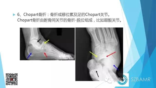 【PPT】(40种)特殊骨折命名方法及图示
