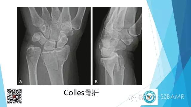 【PPT】(40种)特殊骨折命名方法及图示