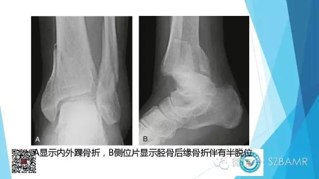 【PPT】(40种)特殊骨折命名方法及图示
