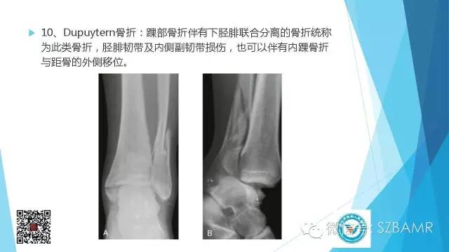 【PPT】(40种)特殊骨折命名方法及图示