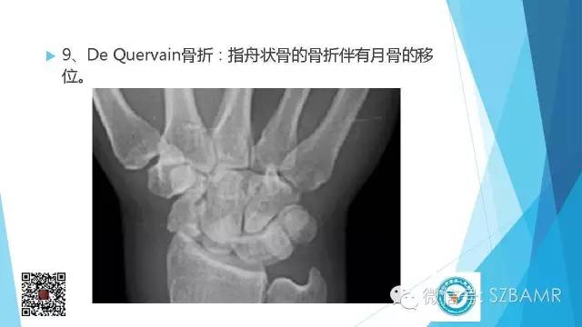 【PPT】(40种)特殊骨折命名方法及图示