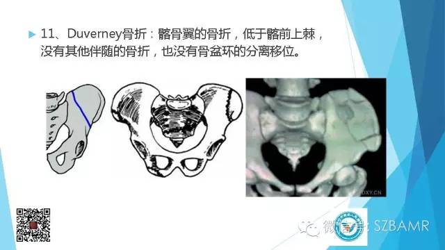 【PPT】(40种)特殊骨折命名方法及图示