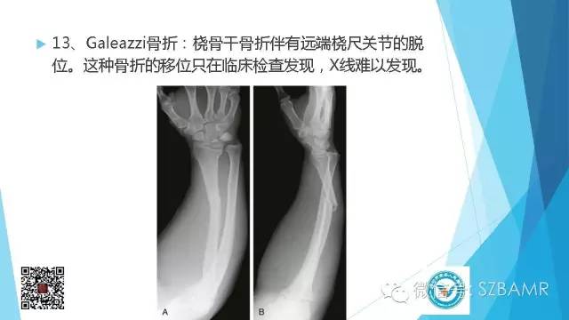 【PPT】(40种)特殊骨折命名方法及图示