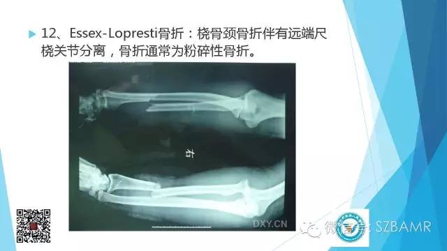 【PPT】(40种)特殊骨折命名方法及图示