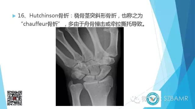 【PPT】(40种)特殊骨折命名方法及图示