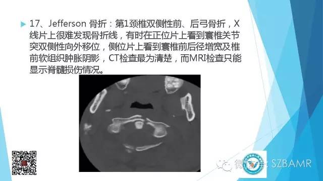 【PPT】(40种)特殊骨折命名方法及图示