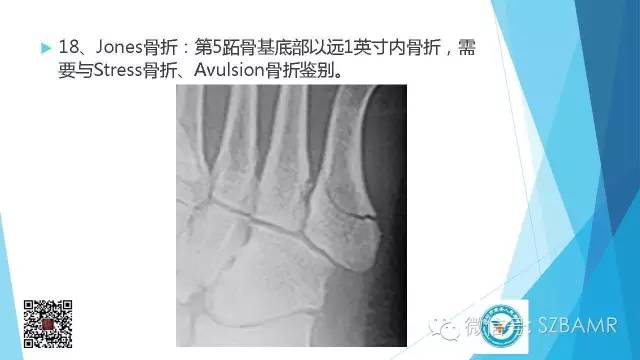 【PPT】(40种)特殊骨折命名方法及图示