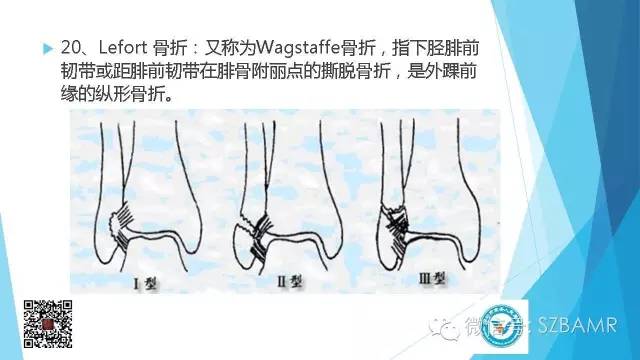 【PPT】(40种)特殊骨折命名方法及图示