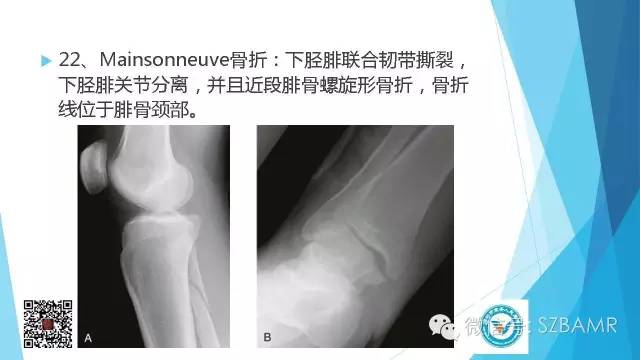 【PPT】(40种)特殊骨折命名方法及图示