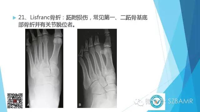 【PPT】(40种)特殊骨折命名方法及图示