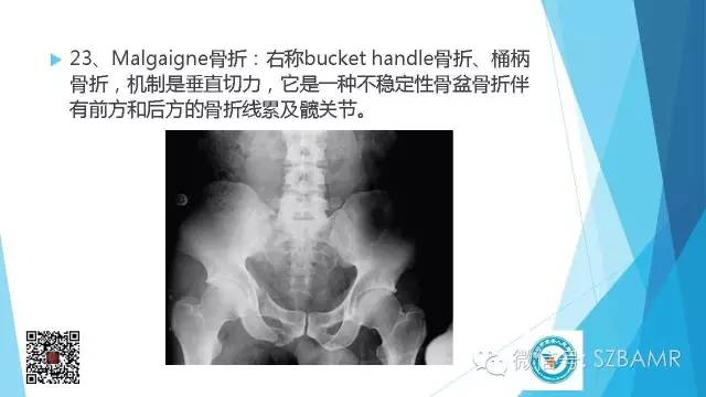 【PPT】(40种)特殊骨折命名方法及图示