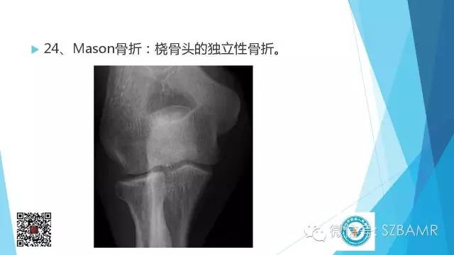【PPT】(40种)特殊骨折命名方法及图示