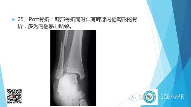 【PPT】(40种)特殊骨折命名方法及图示