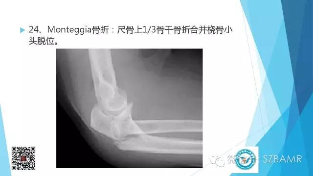 【PPT】(40种)特殊骨折命名方法及图示