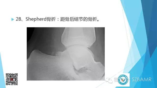 【PPT】(40种)特殊骨折命名方法及图示