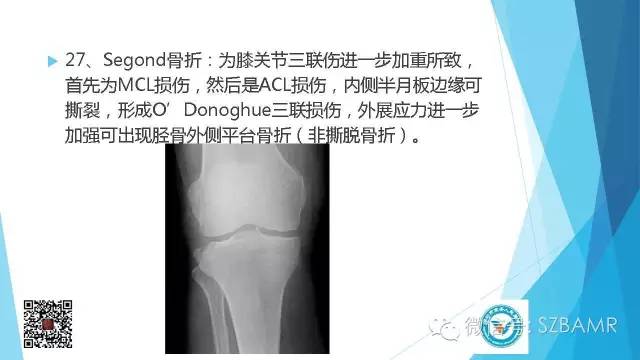 【PPT】(40种)特殊骨折命名方法及图示