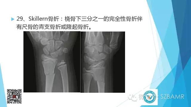 【PPT】(40种)特殊骨折命名方法及图示