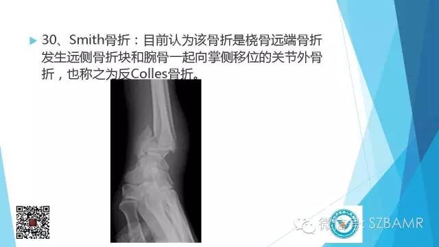 【PPT】(40种)特殊骨折命名方法及图示