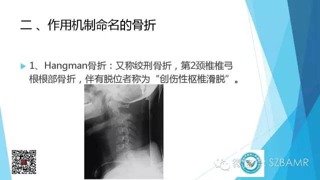 【PPT】(40种)特殊骨折命名方法及图示