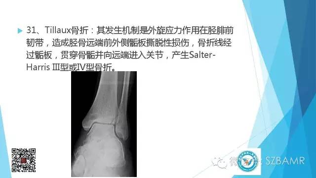 【PPT】(40种)特殊骨折命名方法及图示