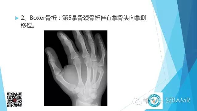 【PPT】(40种)特殊骨折命名方法及图示