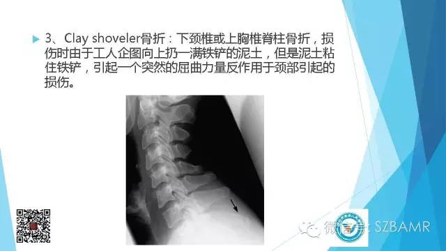 【PPT】(40种)特殊骨折命名方法及图示