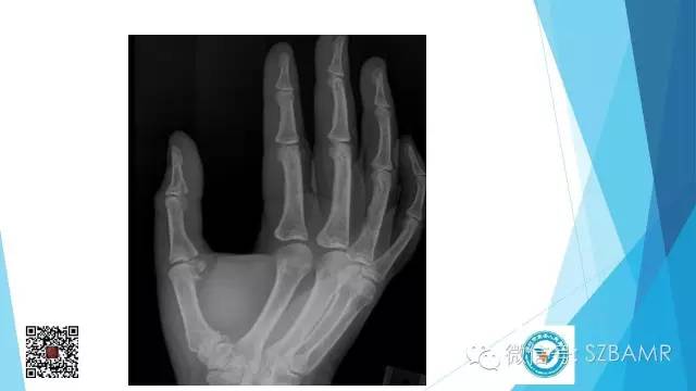 【PPT】(40种)特殊骨折命名方法及图示