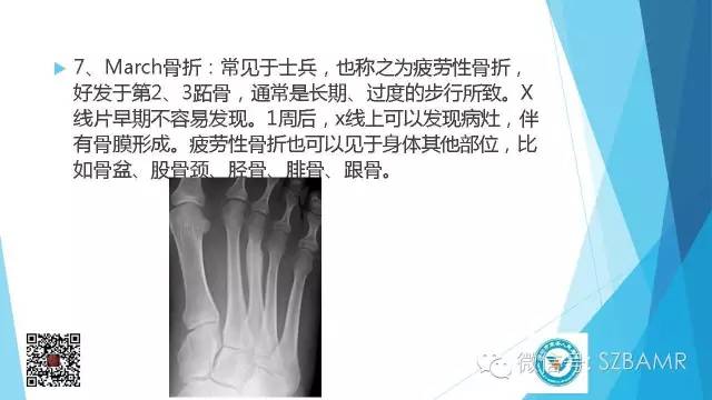 【PPT】(40种)特殊骨折命名方法及图示