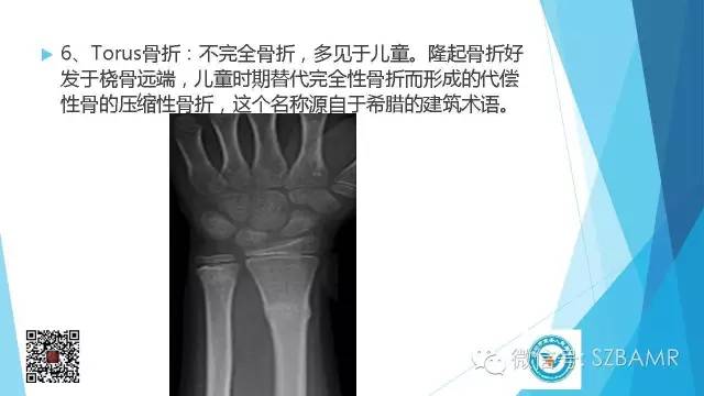 【PPT】(40种)特殊骨折命名方法及图示